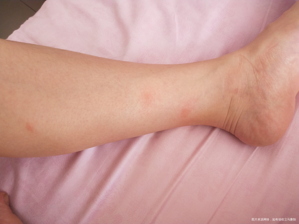 求助医生,我怀孕33周了身上长包了,特痒