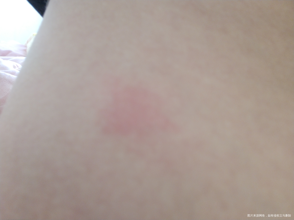 求助医生,我怀孕33周了身上长包了,特痒