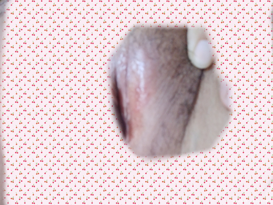 请帮忙看一下我这是怎么了?有图,有点不雅,请见谅。