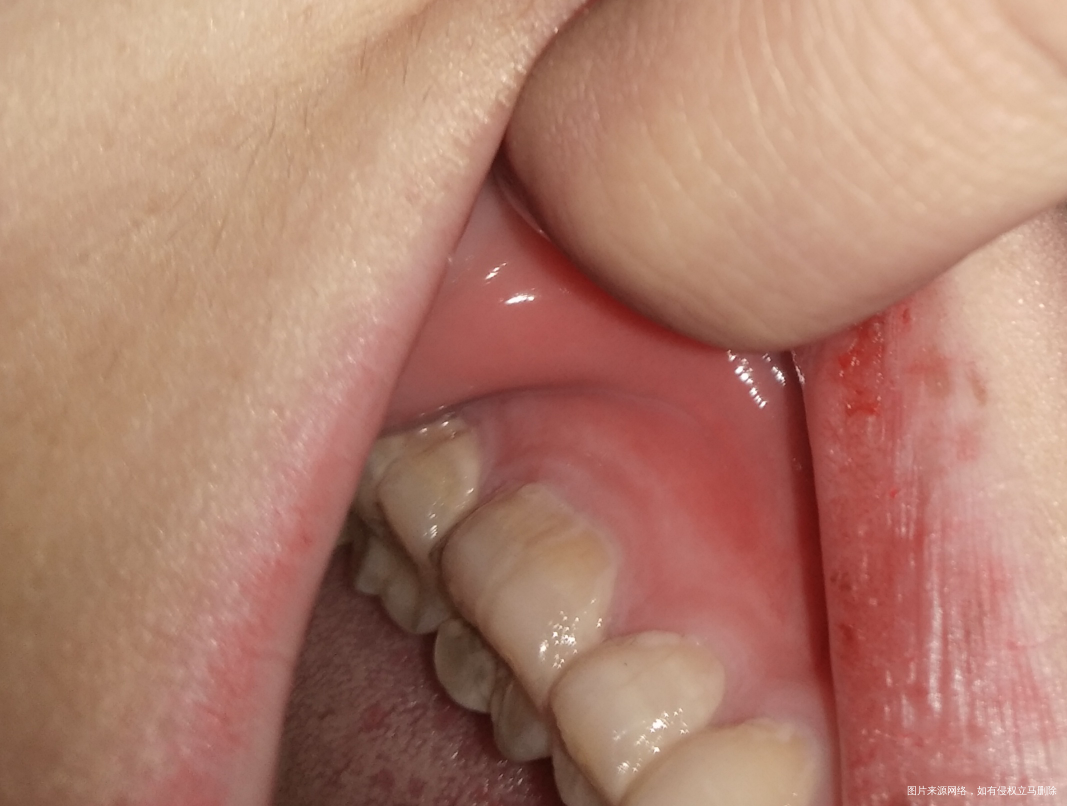 求助医生帮帮我,急急急 孕期牙疼厉害。