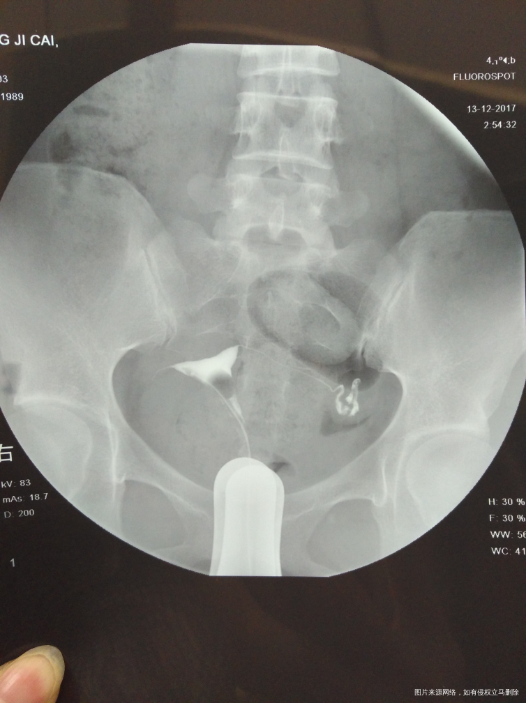 输卵管通而不畅应该怎么治疗