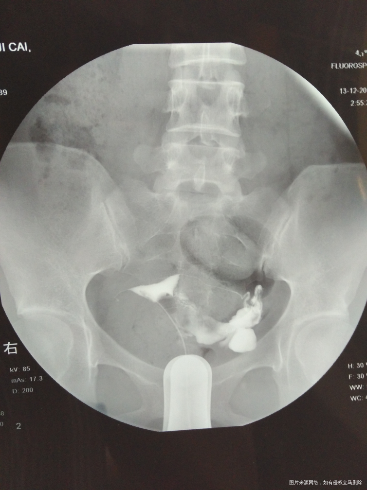 输卵管通而不畅应该怎么治疗