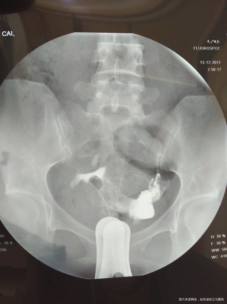 输卵管通而不畅应该怎么治疗