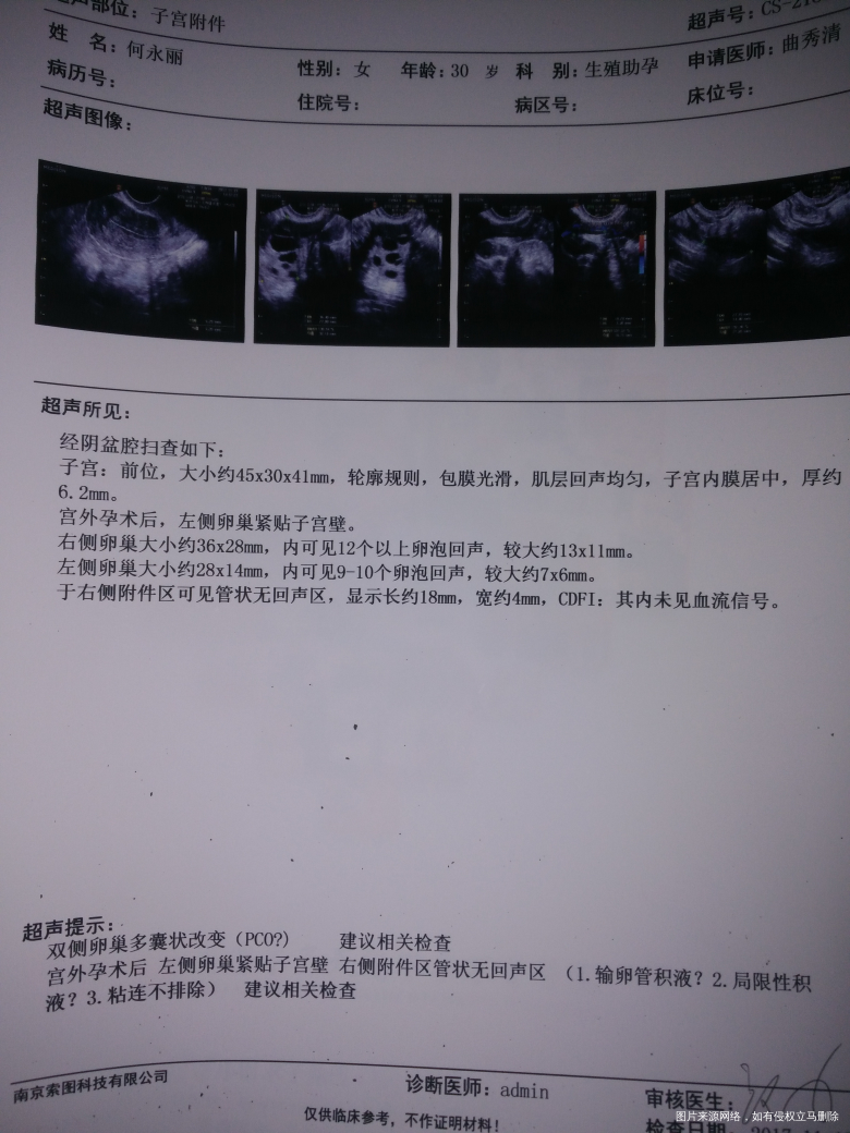 多囊卵巢,如何治疗,能医疗吗,谢谢