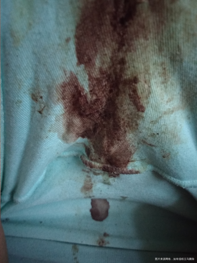 怀孕7/8周有血丝,担心中