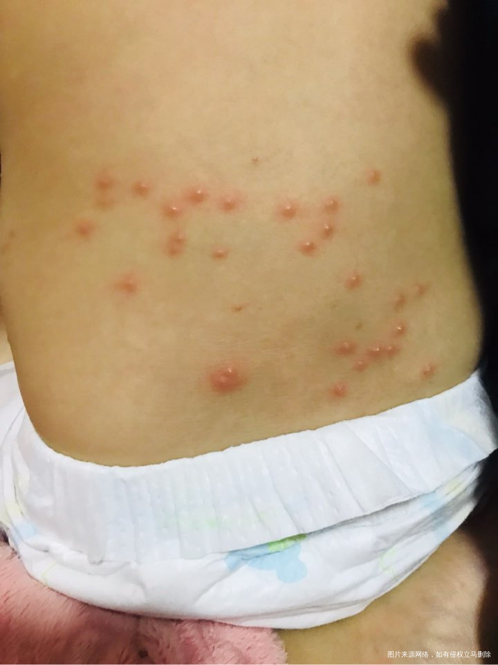 都有一周了,医院开了康复新液擦也不见好。还是没消,麻烦医生帮忙看看