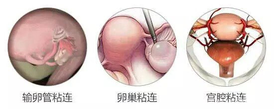【宫腔粘连】阻挡不了好孕