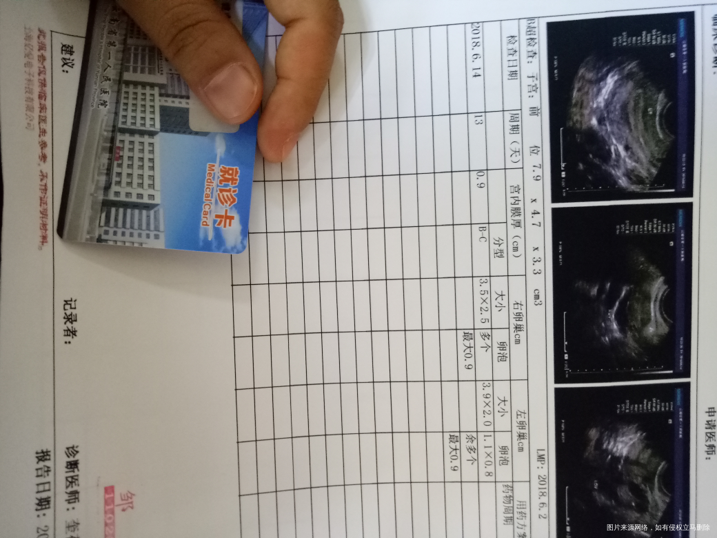 多囊促排,月经第13天监测