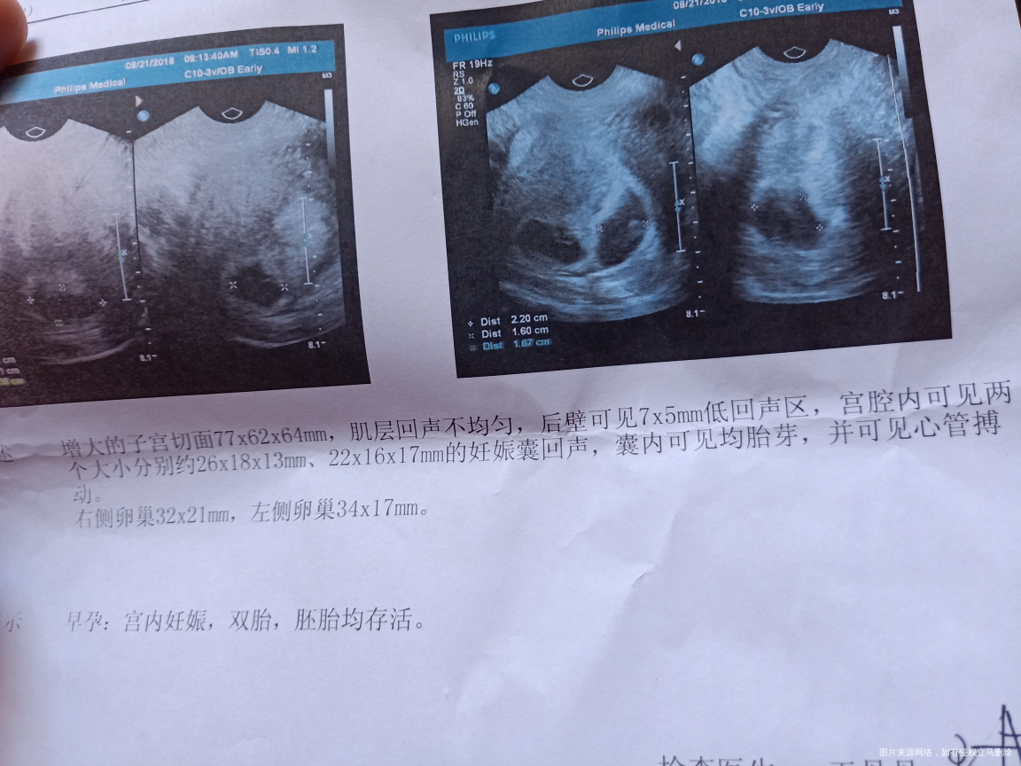 今天一超,双双,不知男女宝啊?