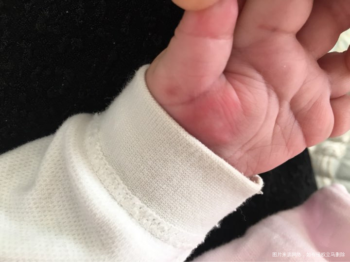 宝宝脸上手上出现大红包