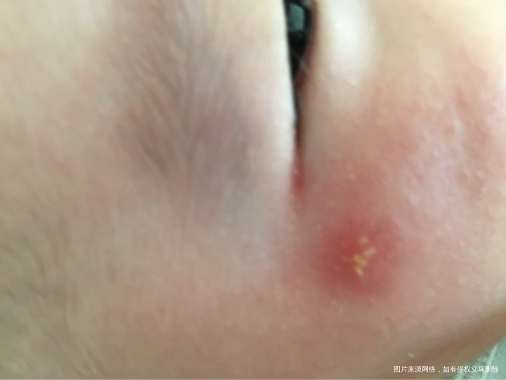 宝宝脸上手上出现大红包