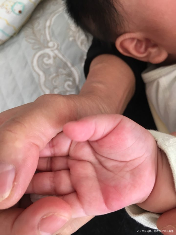 宝宝脸上手上出现大红包