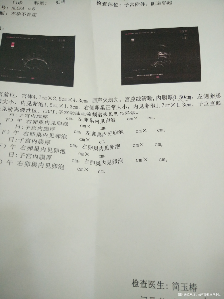 多囊促排卵,监测卵泡阶段。