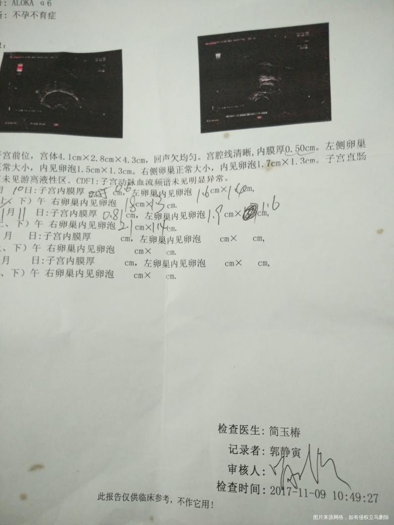 月经第十四天监测的卵泡。