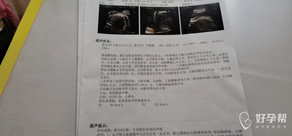 四维彩超和心动图有点问题.有一样情况的吗?
