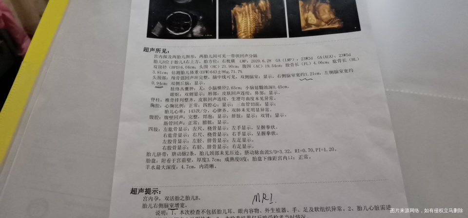 四维彩超和心动图有点问题。有一样情况的吗?