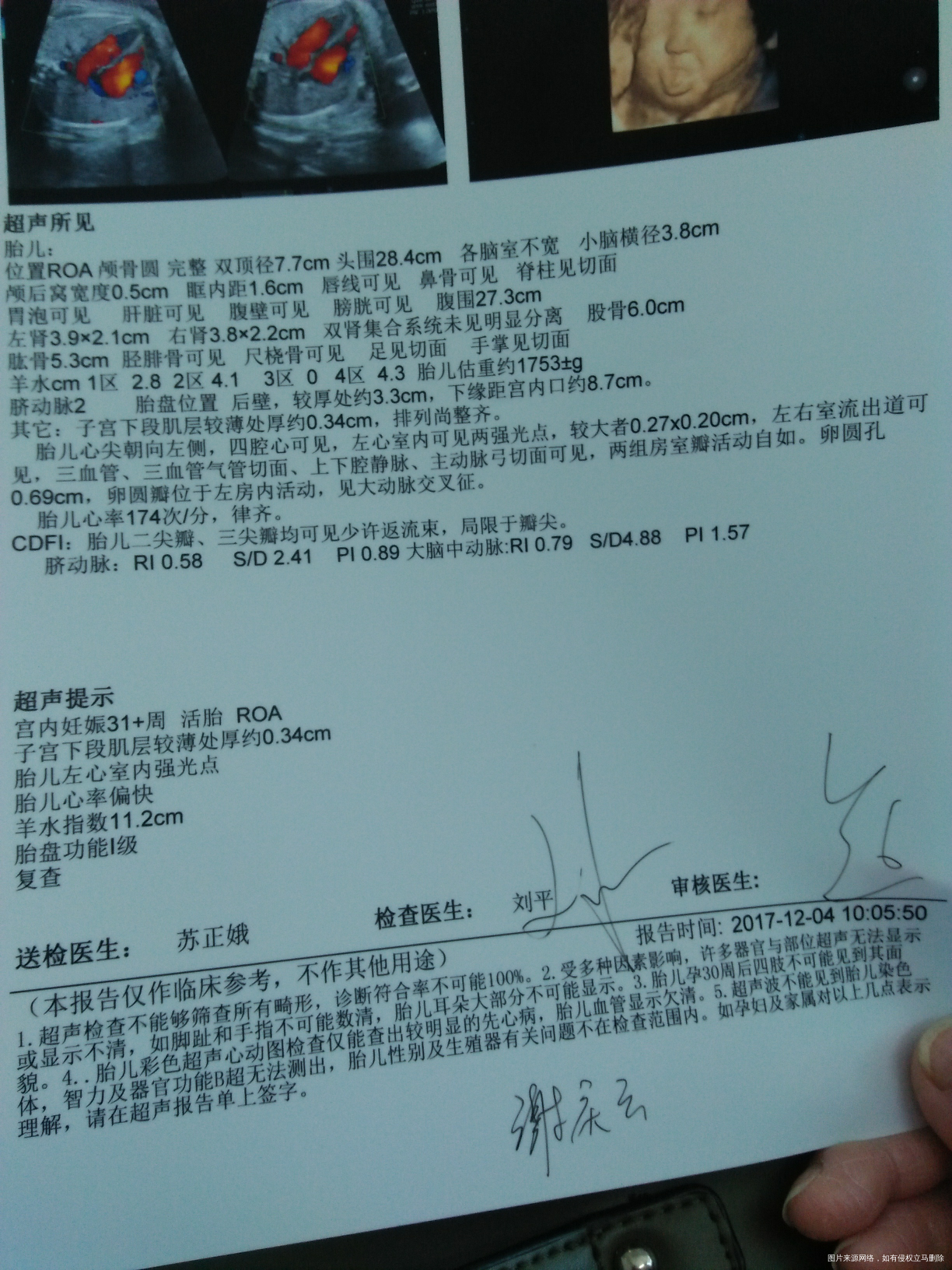 孕31周+3四维报告麻烦医生帮忙看看