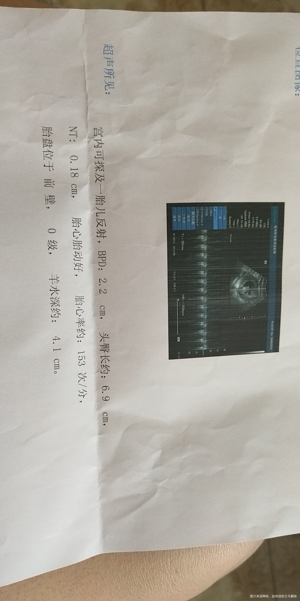 nt完还需抽血做什么检查