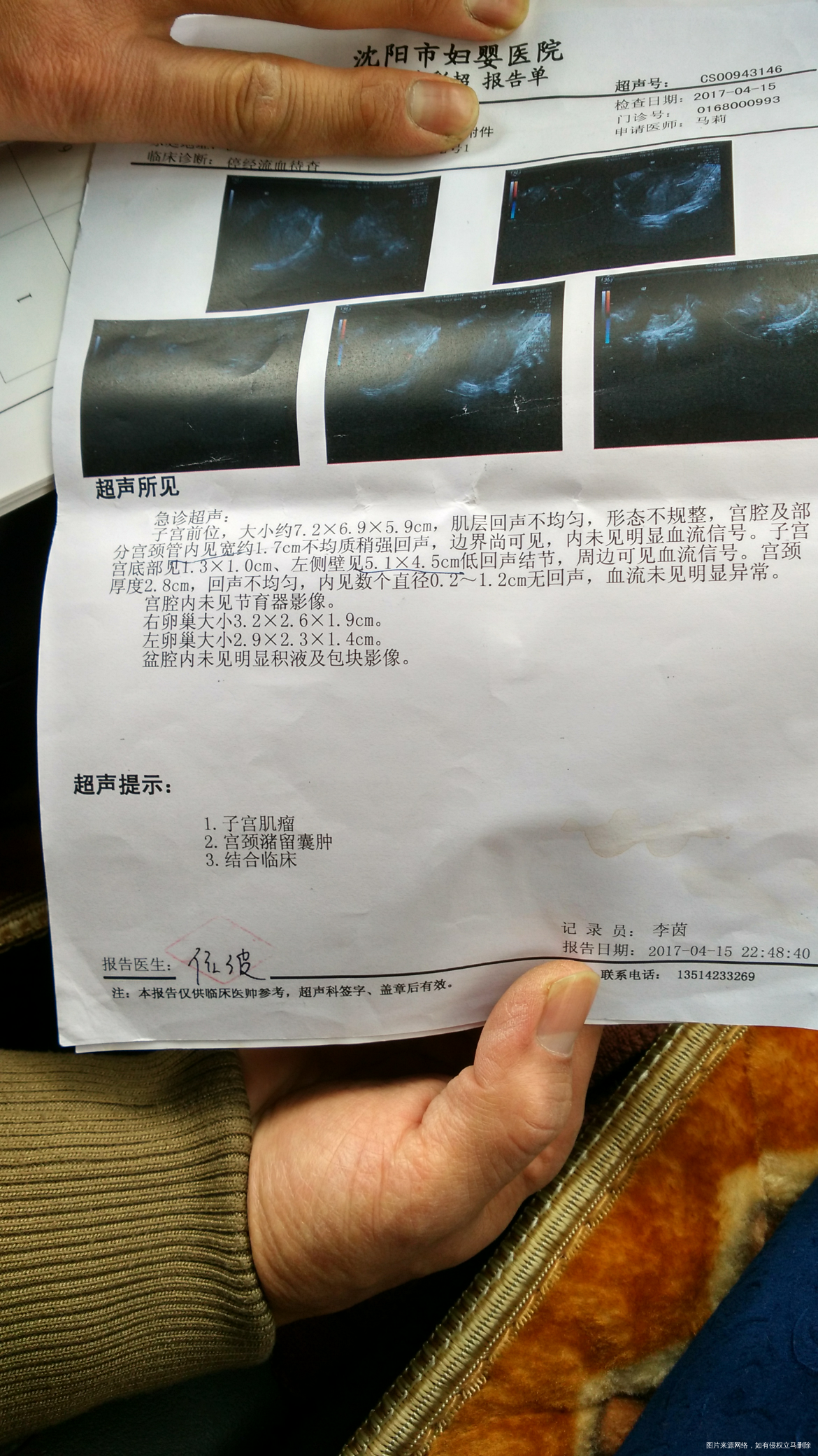 自然流产 b超检查有子宫肌瘤