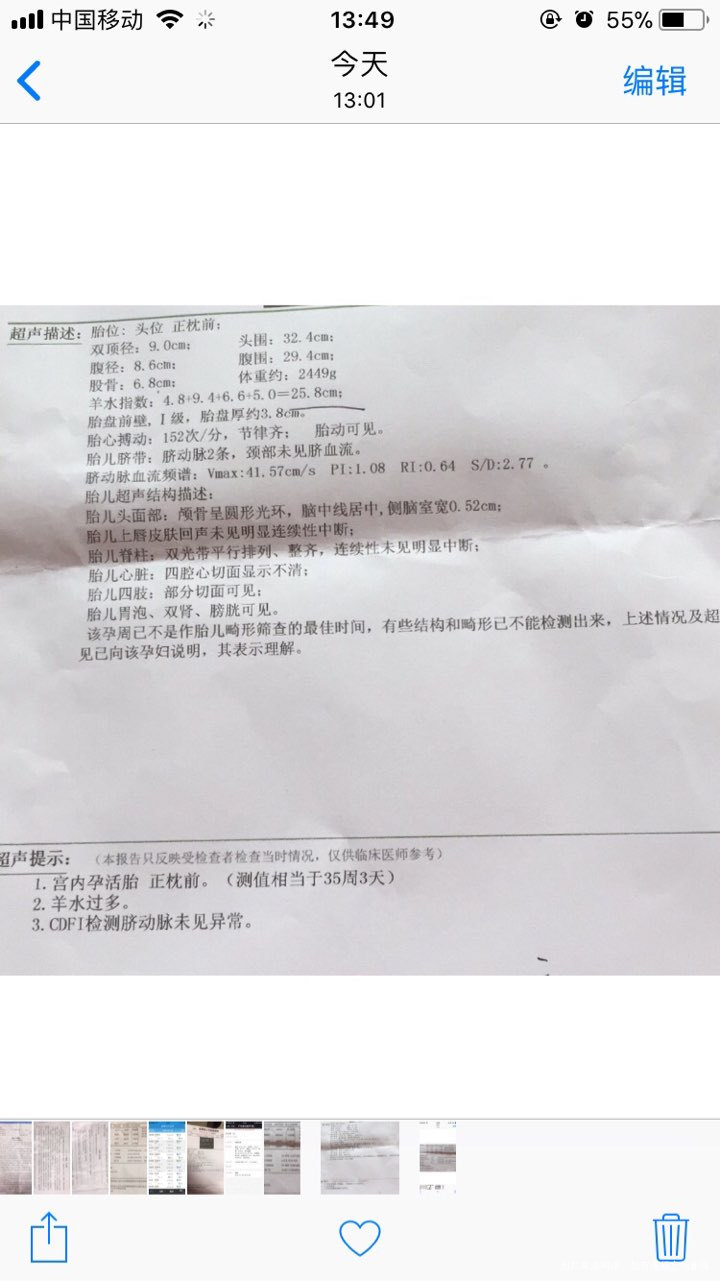 羊水偏多 胎儿偏大和唐氏筛查报告有没有什么关系?