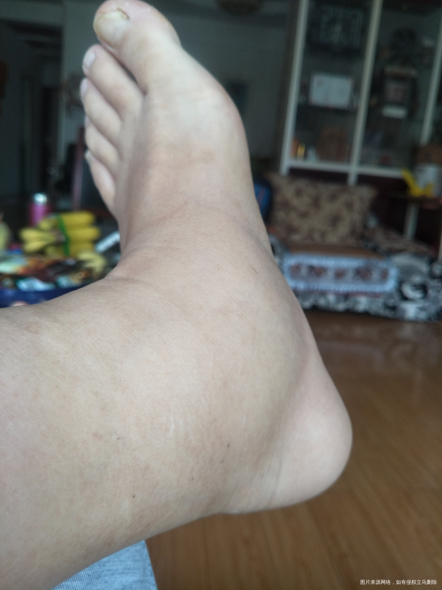 怀孕32周,脚开始水肿