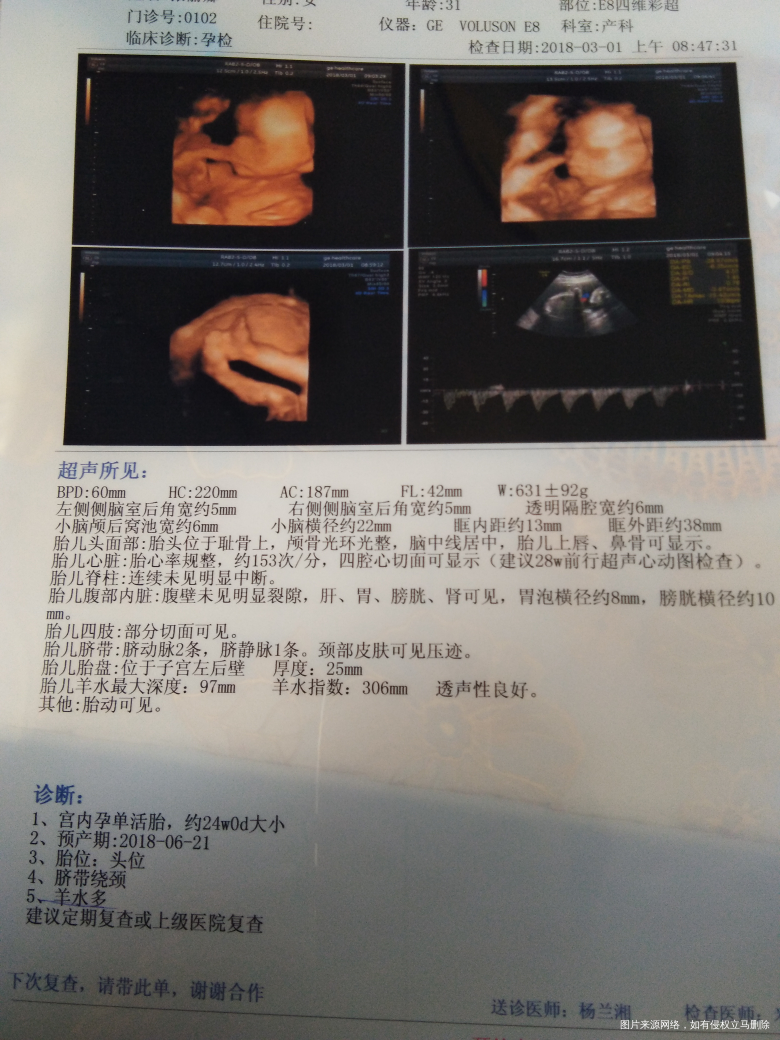 刚做的四维,顺利通过,宝宝也很健康,就是羊水多,没关系,少喝点水,感谢菩萨的保佑...