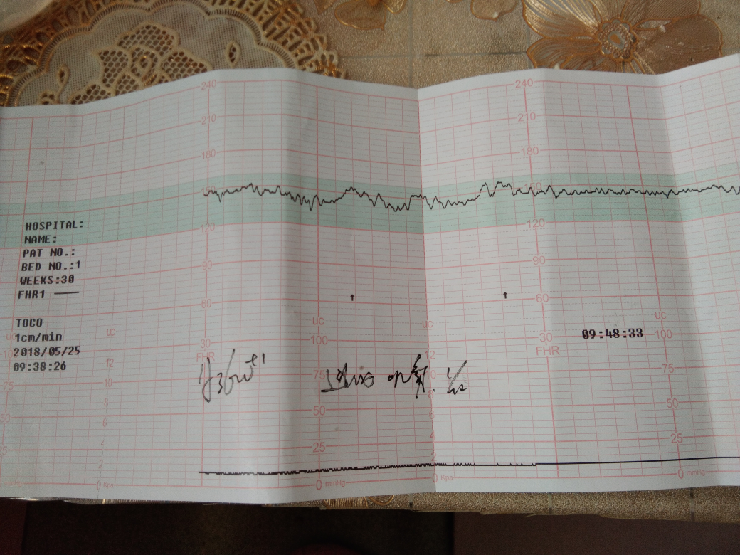 今天第一次做胎心监护,7分,不知道好不好,医生说胎动的时候有波动