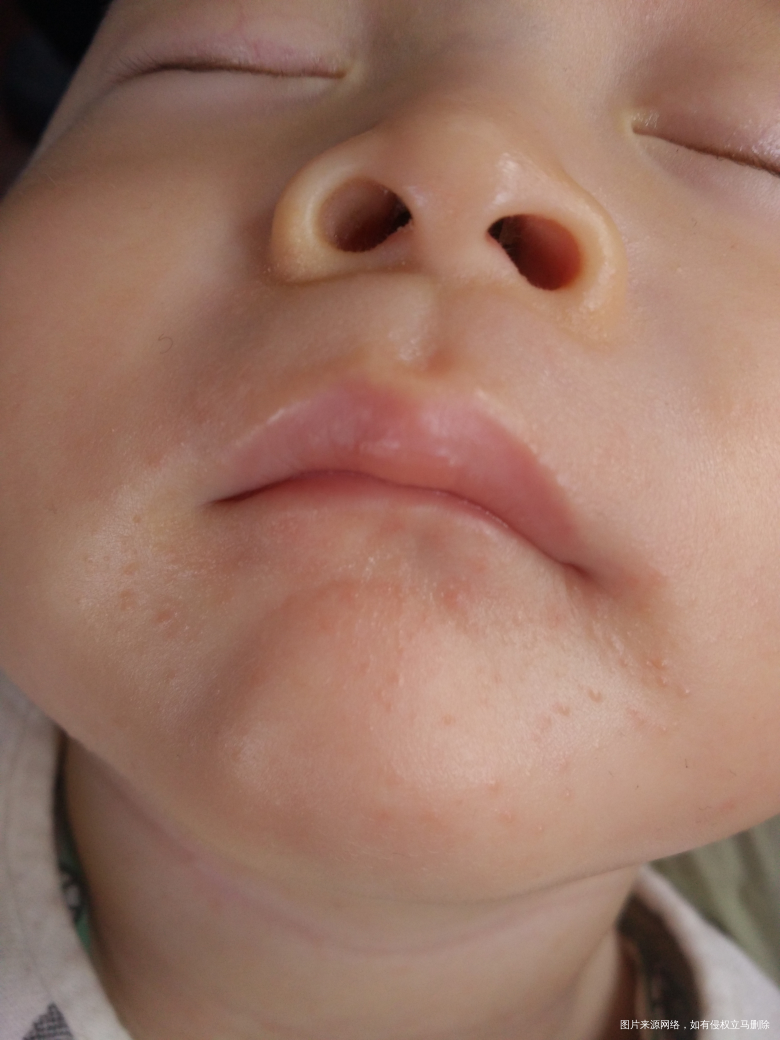 医生帮忙看看宝宝这个是起的什么?
