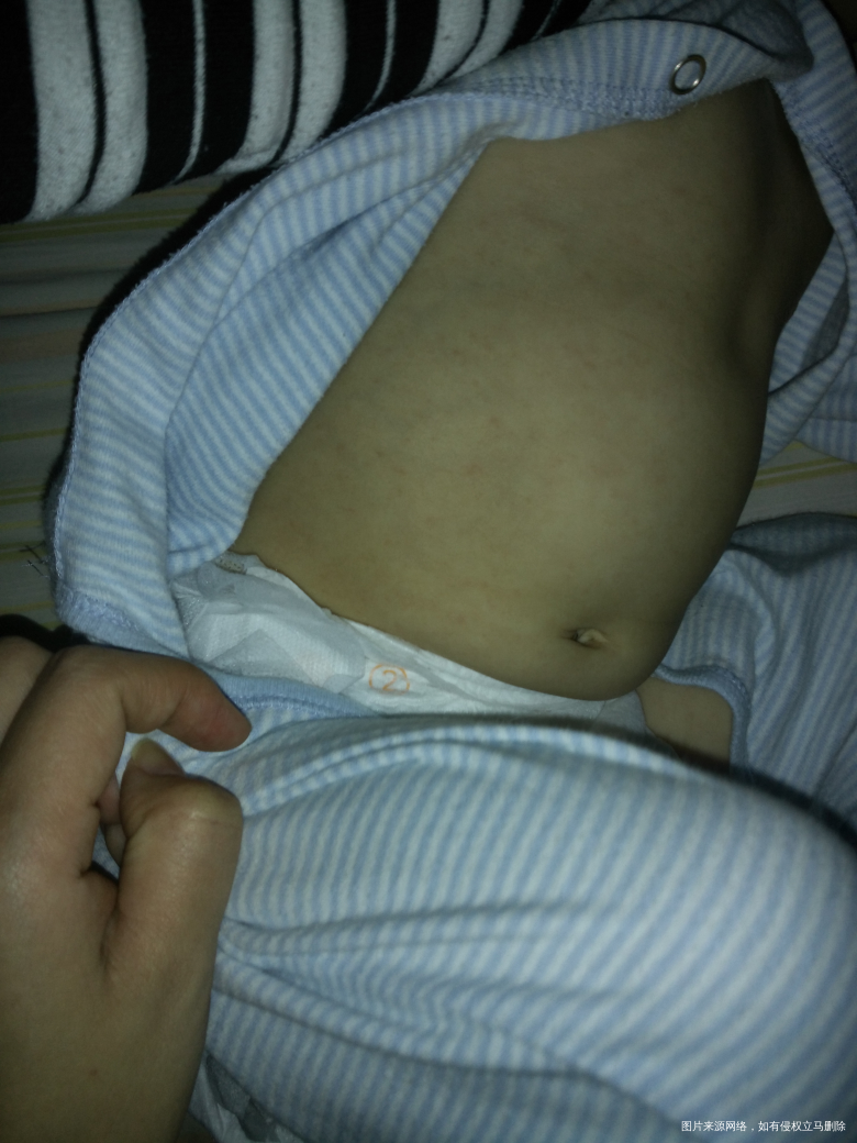 宝宝常见病之幼儿急疹的一点经验