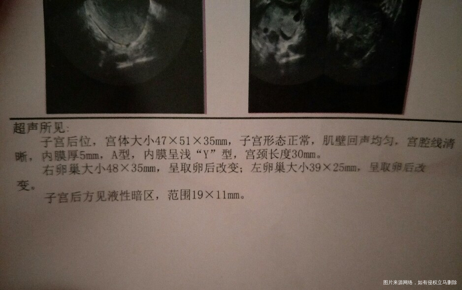 取卵后卵巢恢复,图片是取卵没用药前、取完卵第三天、取卵后月经完事三天