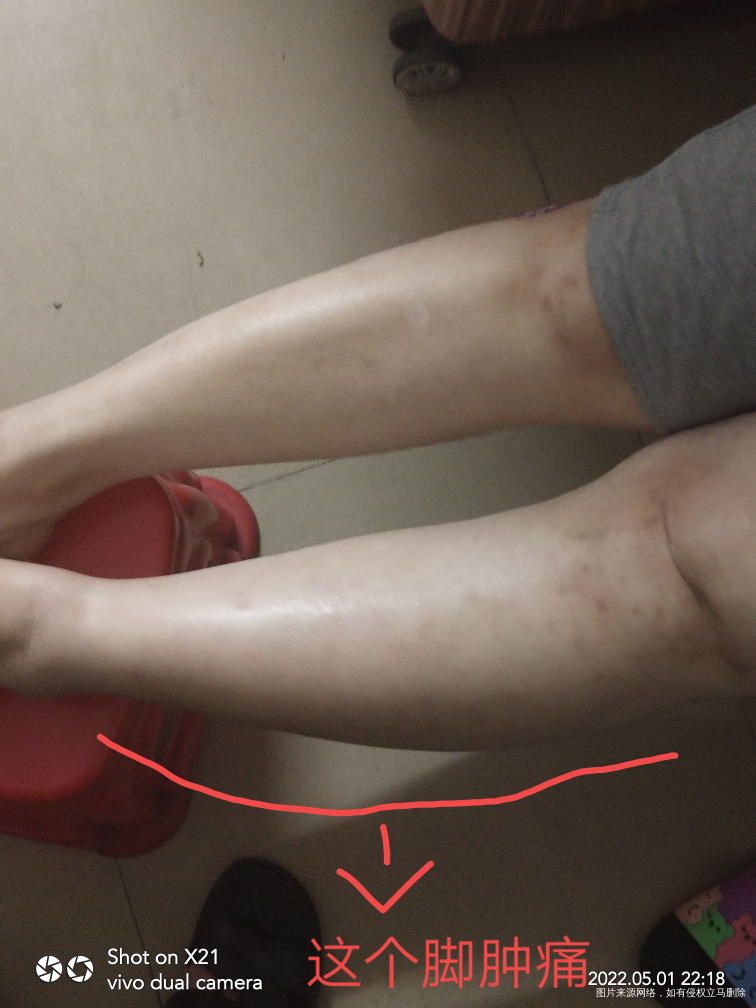 各位医生麻烦你们帮我分析一下,孕14周了,下去活动的时候没走多久,然后这左脚肿痛...