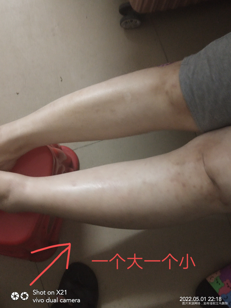 各位医生麻烦你们帮我分析一下,孕14周了,下去活动的时候没走多久,然后这左脚肿痛...