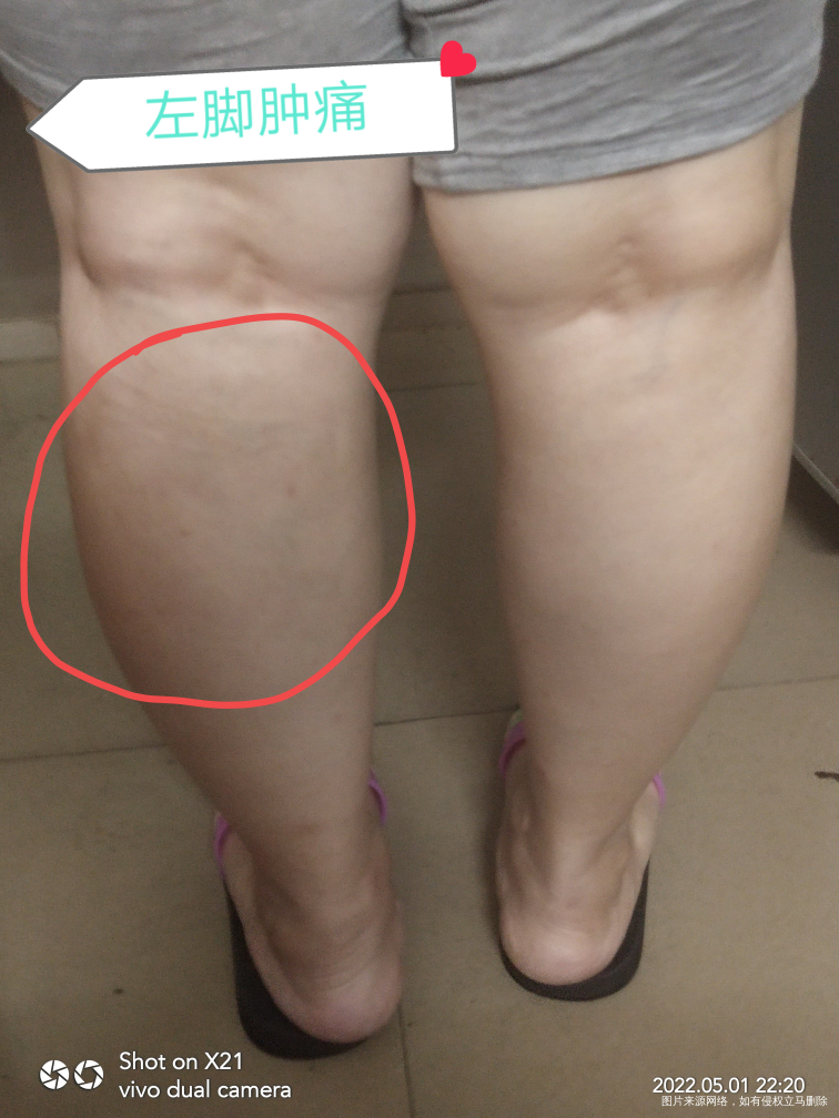各位医生麻烦你们帮我分析一下,孕14周了,下去活动的时候没走多久,然后这左脚肿痛...