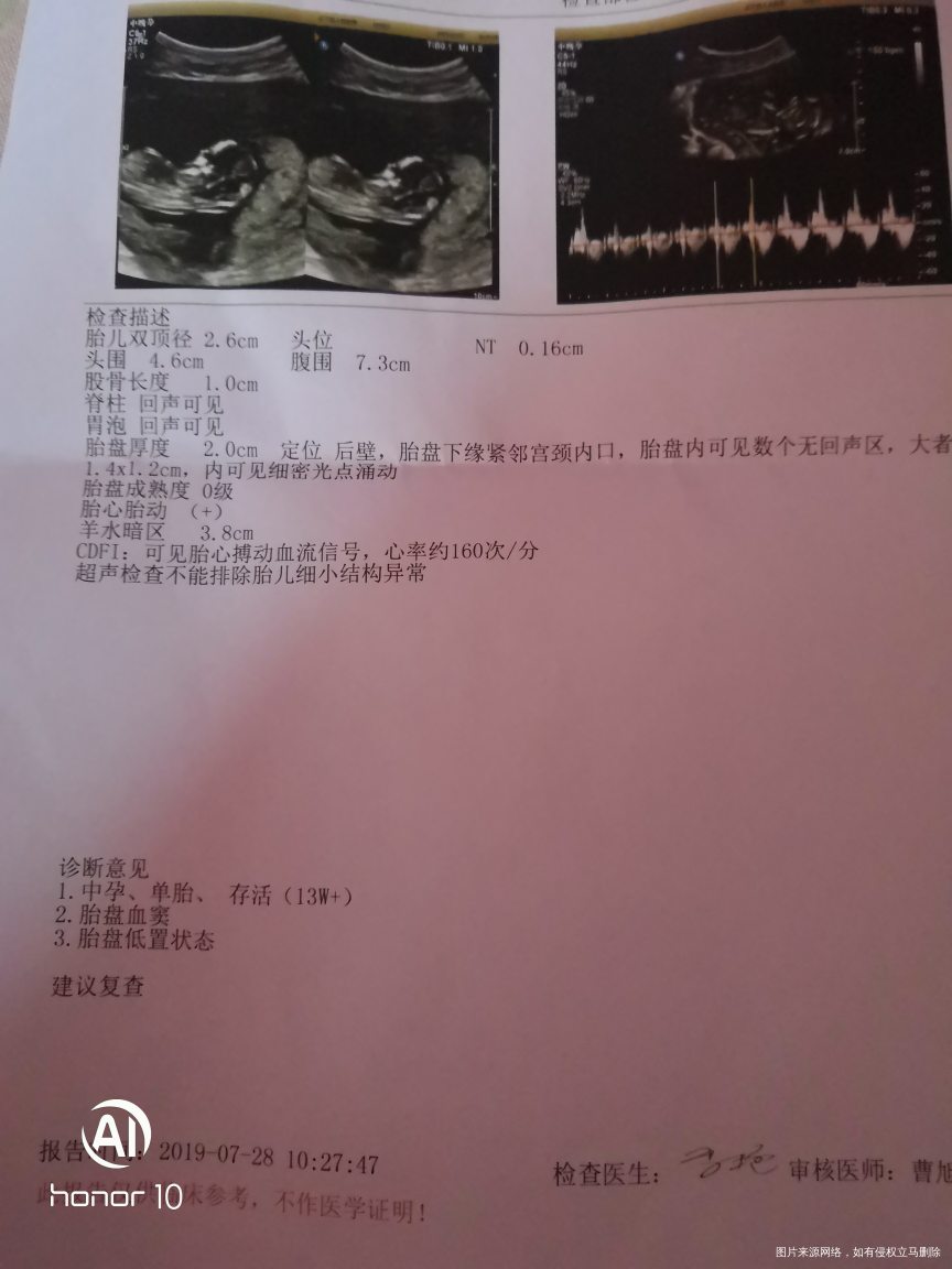 医生麻烦帮我看看Nt单子,谢谢