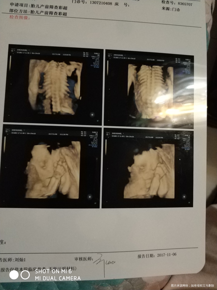 四维检查单24+2,胎盘成熟一级