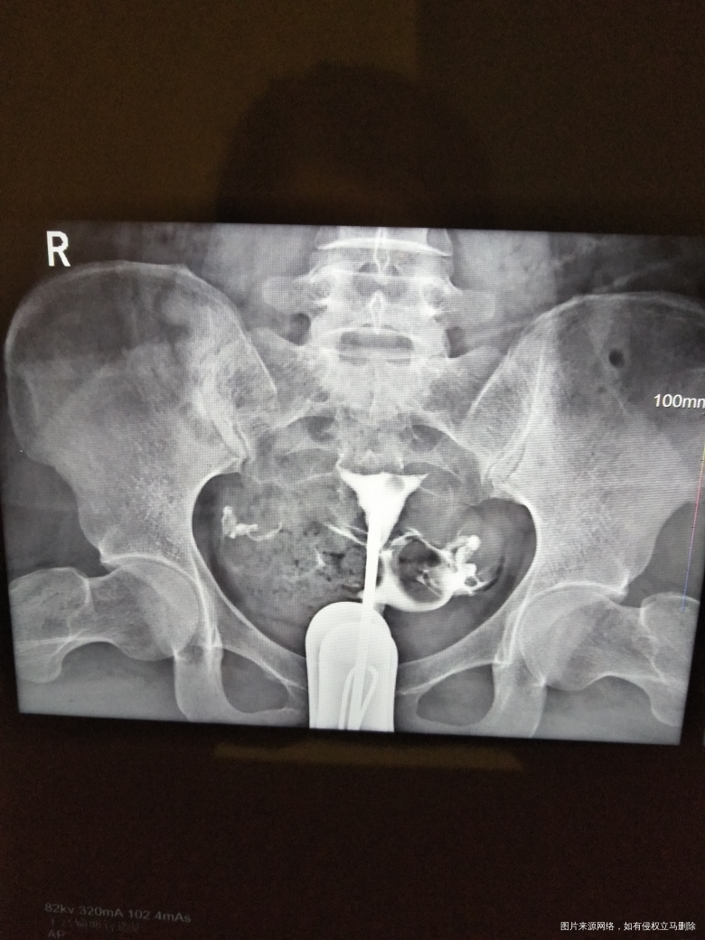 求助帮忙看看造影片子