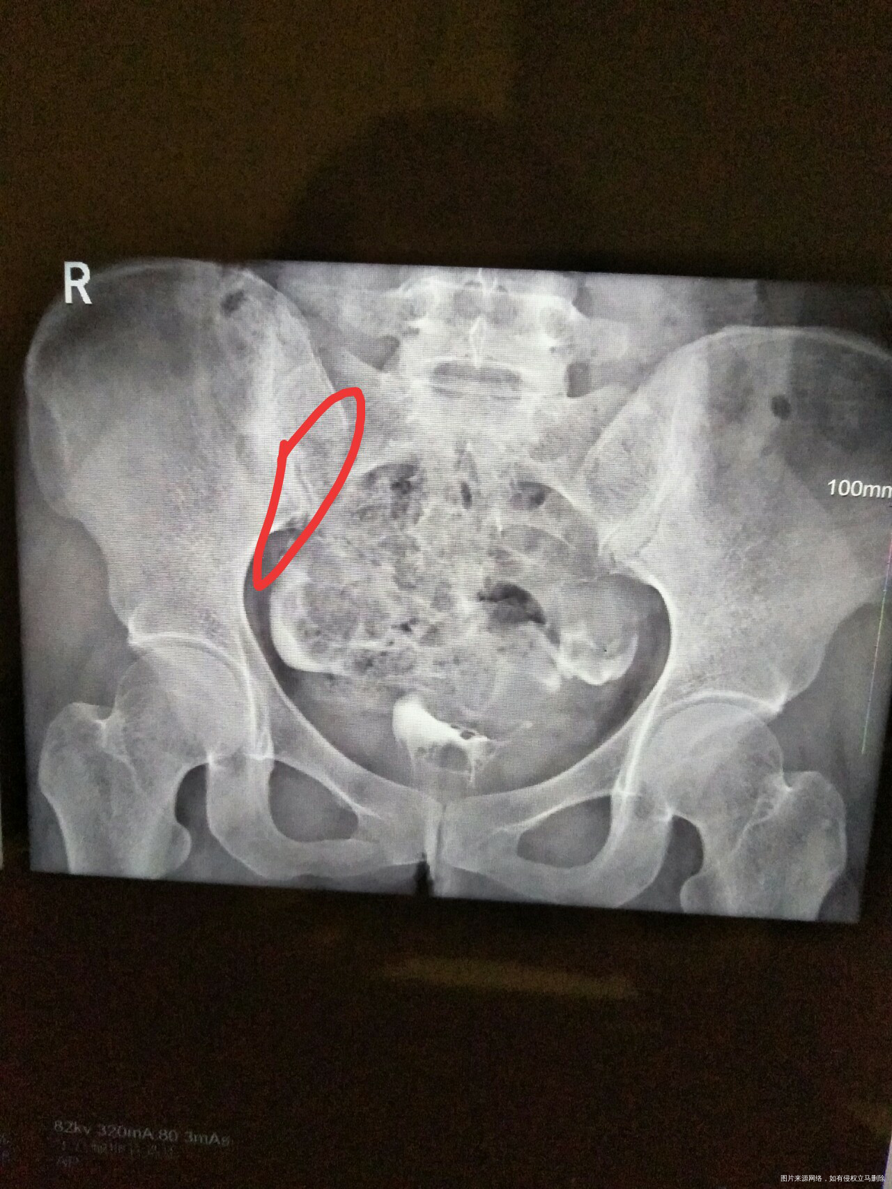 求助帮忙看看造影片子