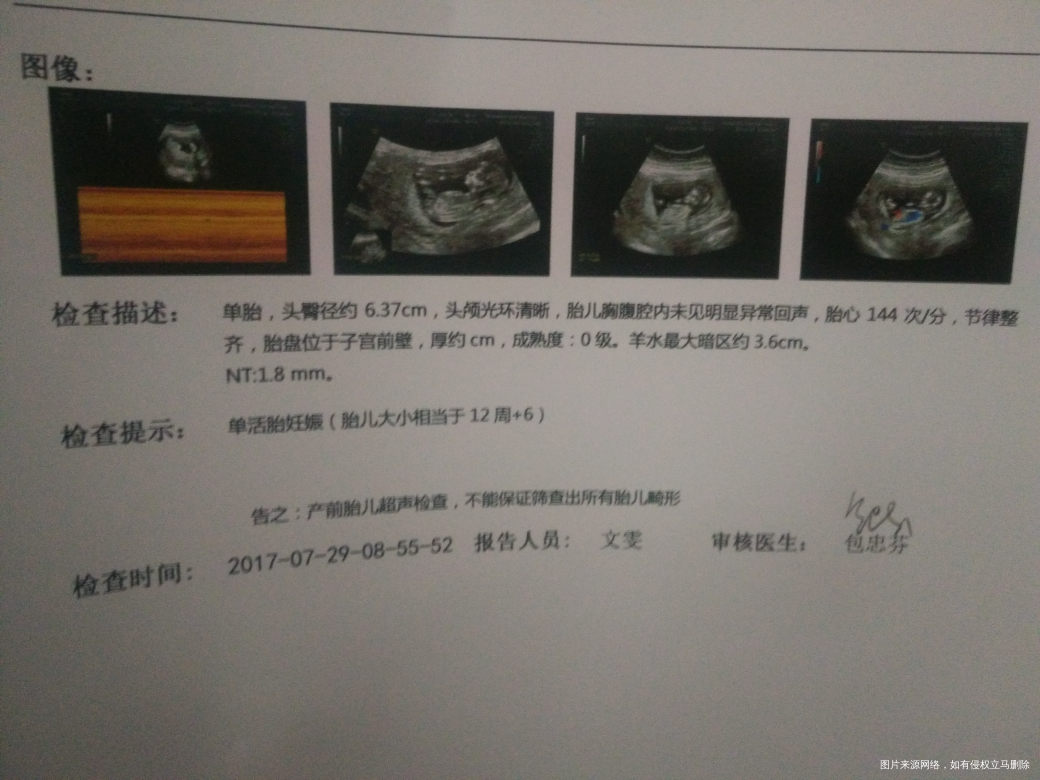 医生帮忙看一下这NT的检查结果正常吗