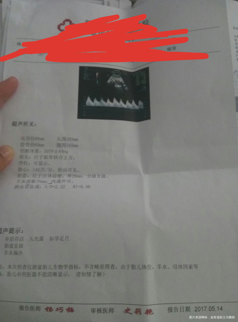 我38周,彩超显示羊水指数76,要不要住院催生呢?