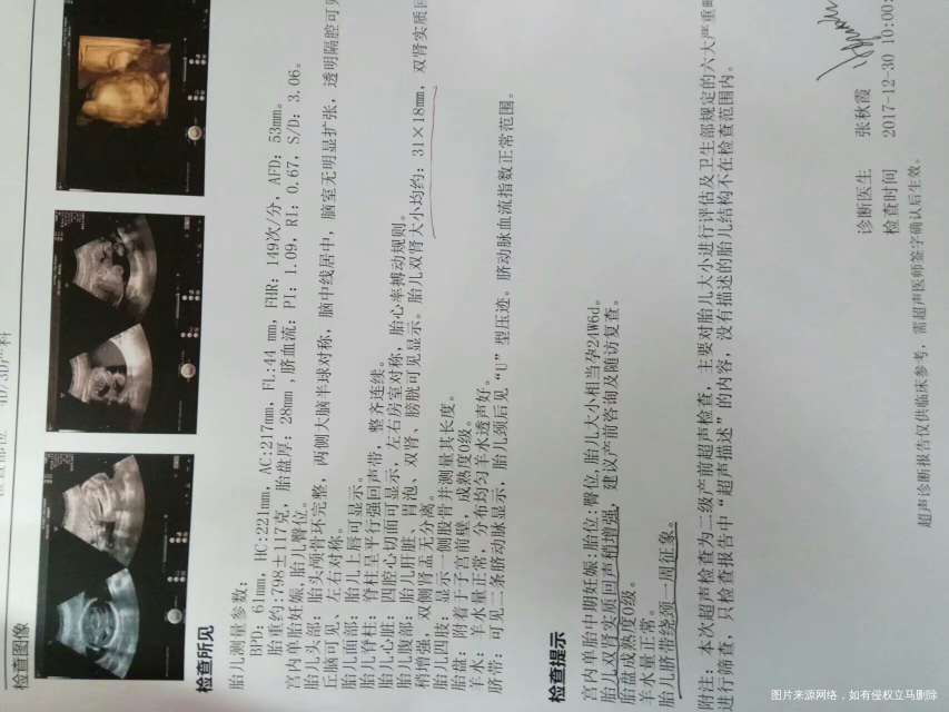 求助医生…好担心啊 胎儿双肾回声稍微强问题大不大