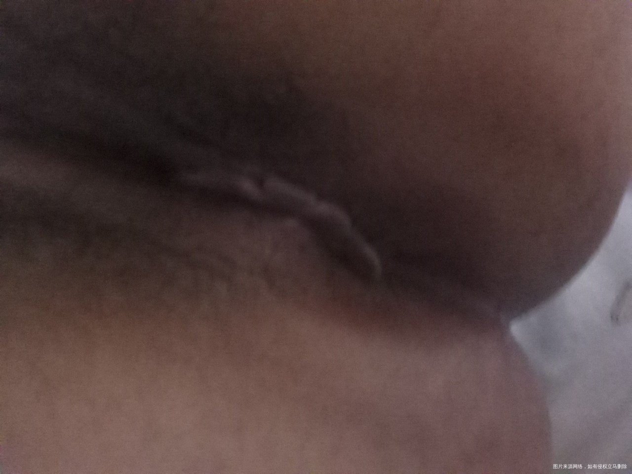 求助医生。顺产10天。伤口很痛