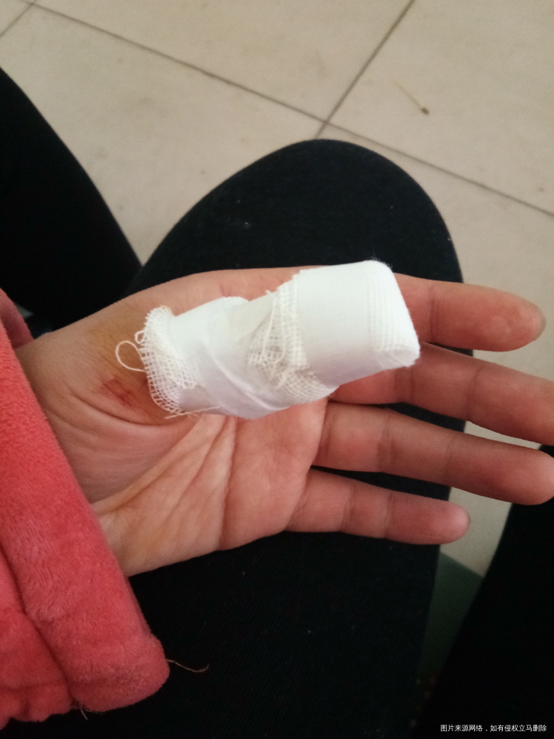 手指头被砸了一下,快疼死我了