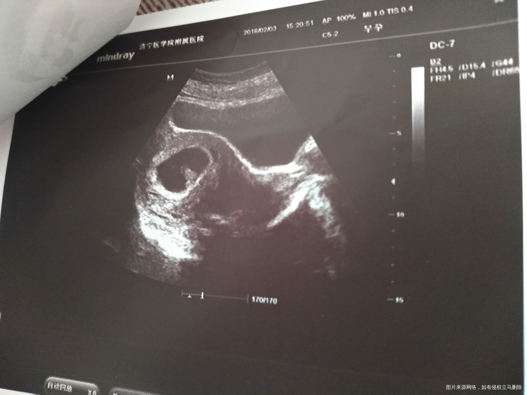 怀孕58天还是不能出去走动,一走路就流血,什么时候可以好呢?