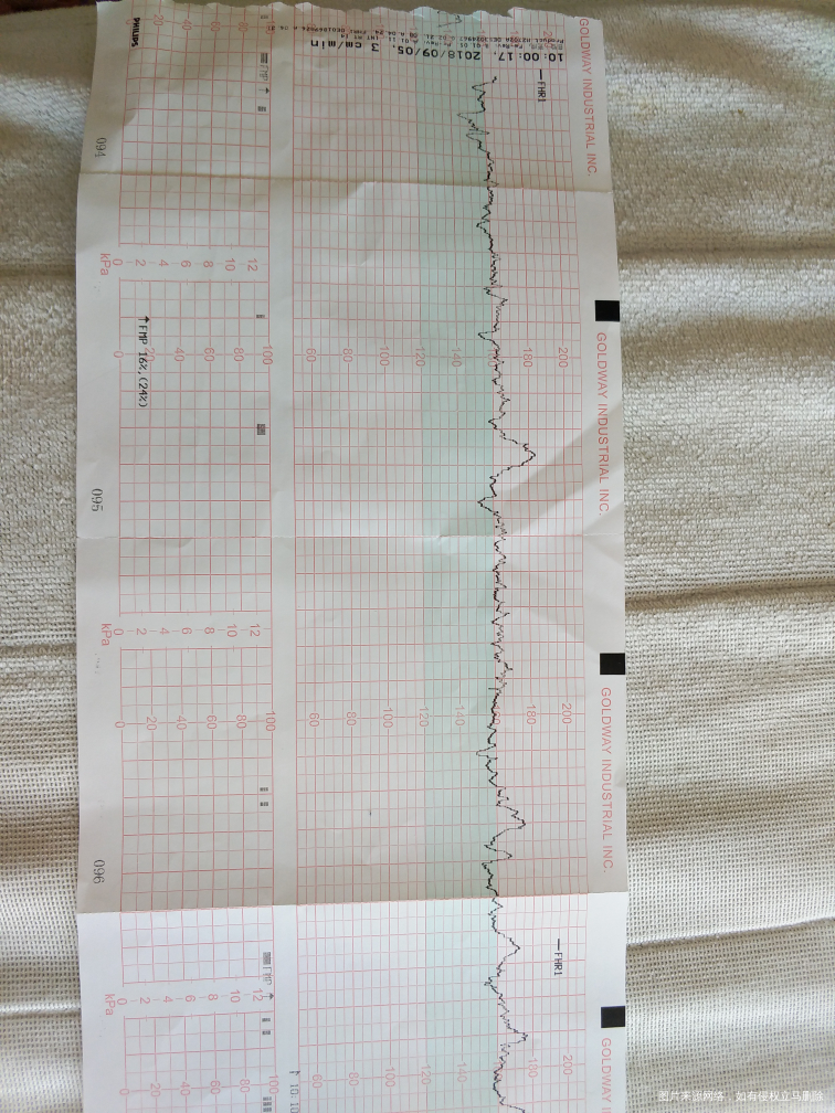 求助医生,胎心监护不过关