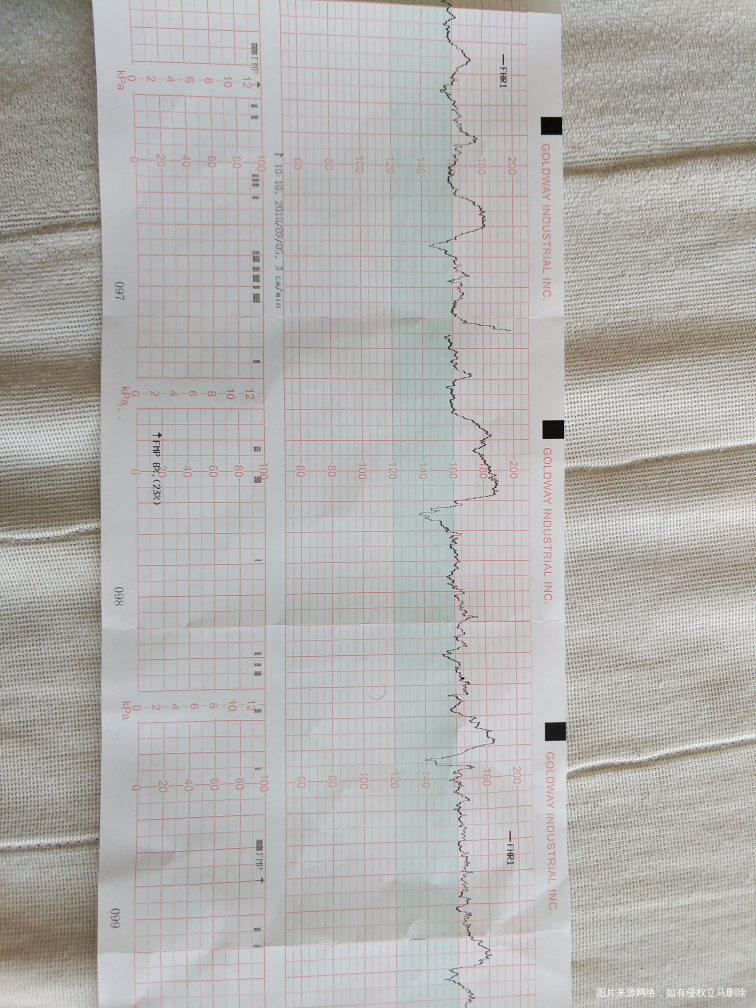 求助医生,胎心监护不过关