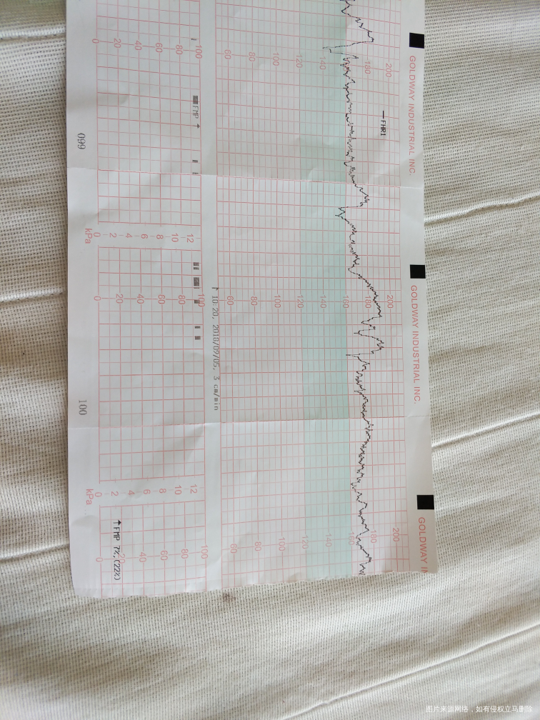 求助医生,胎心监护不过关