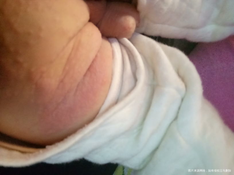 宝宝被蚊子咬了给买了药水洗澡后,这样了