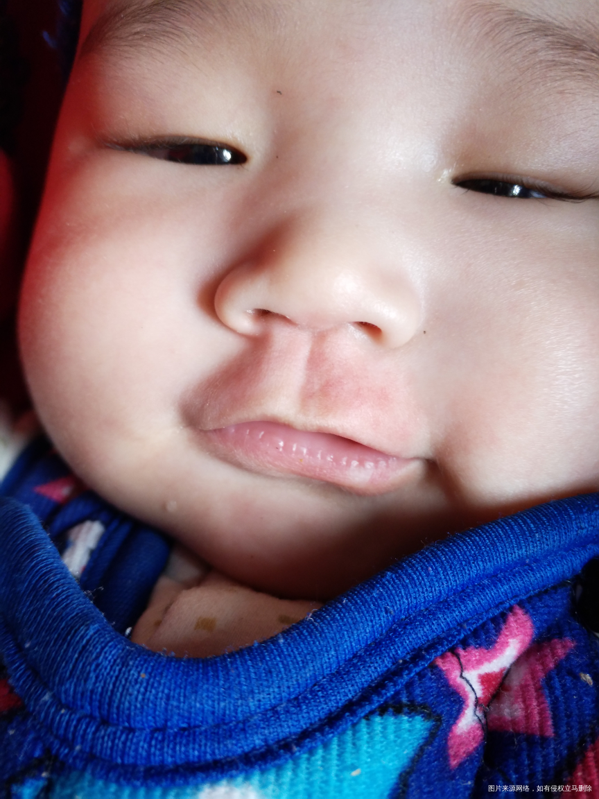 宝宝从两个月的时候发现嘴唇有白点现在快五个月了白点变大