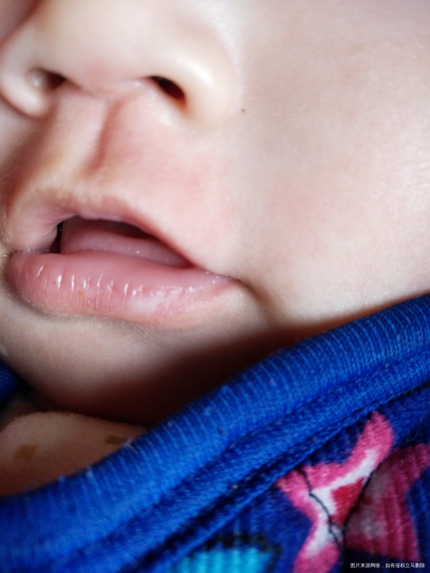 宝宝从两个月的时候发现嘴唇有白点现在快五个月了白点变大
