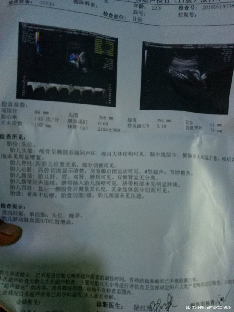二胎,孕三十四周脐动脉血流S/D3.18